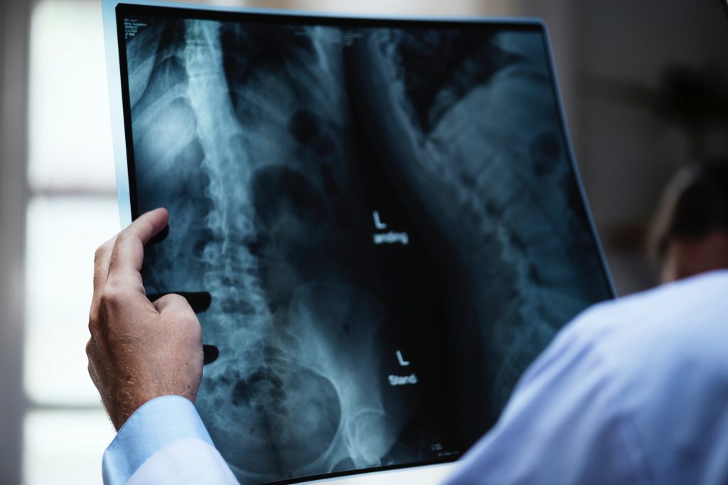 x-ray of spine after a car accident